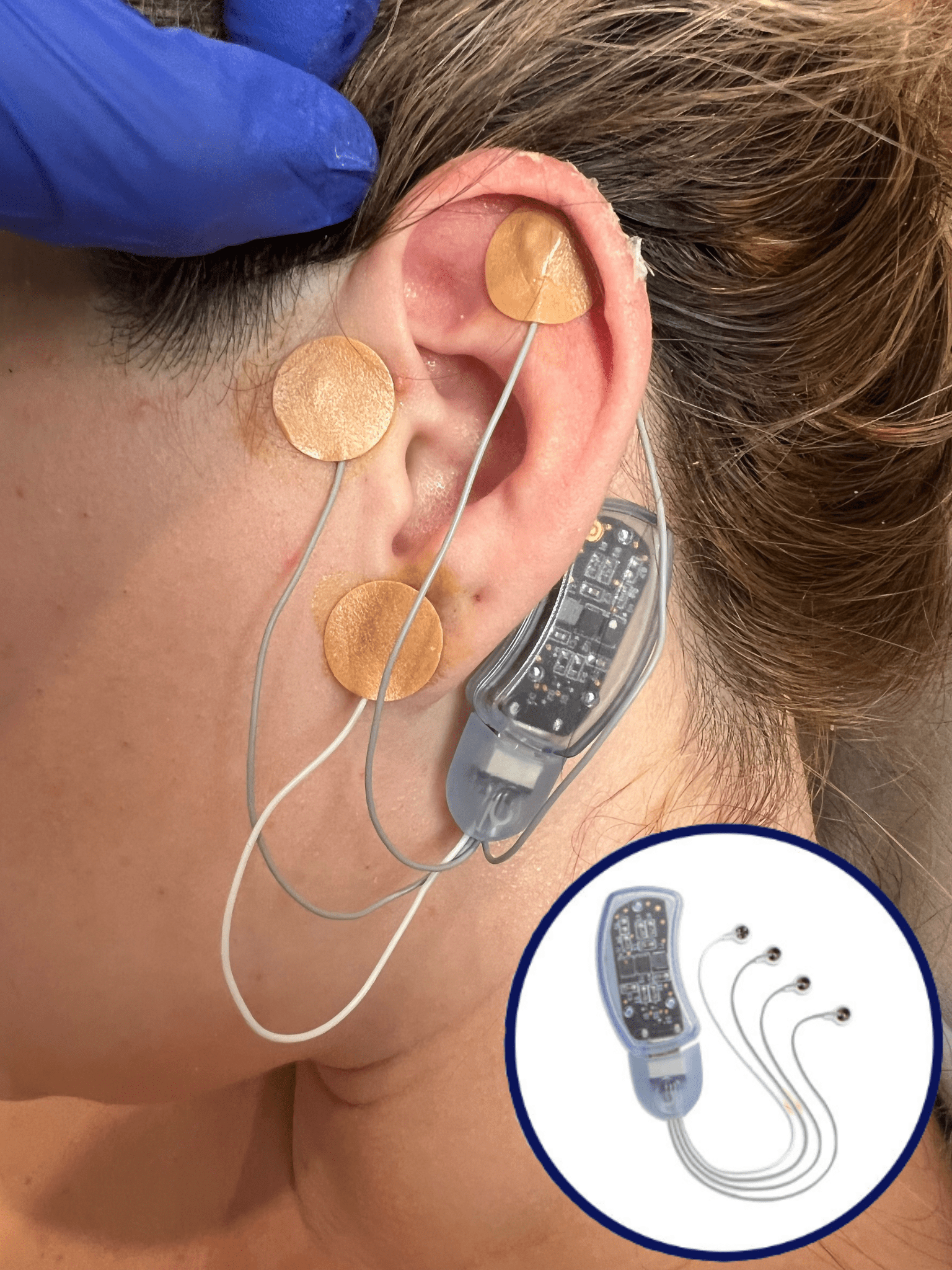 The BRIDGE Device fits behind the ear and sends gentle electrical impulses directly into the brain, blocking pain signals